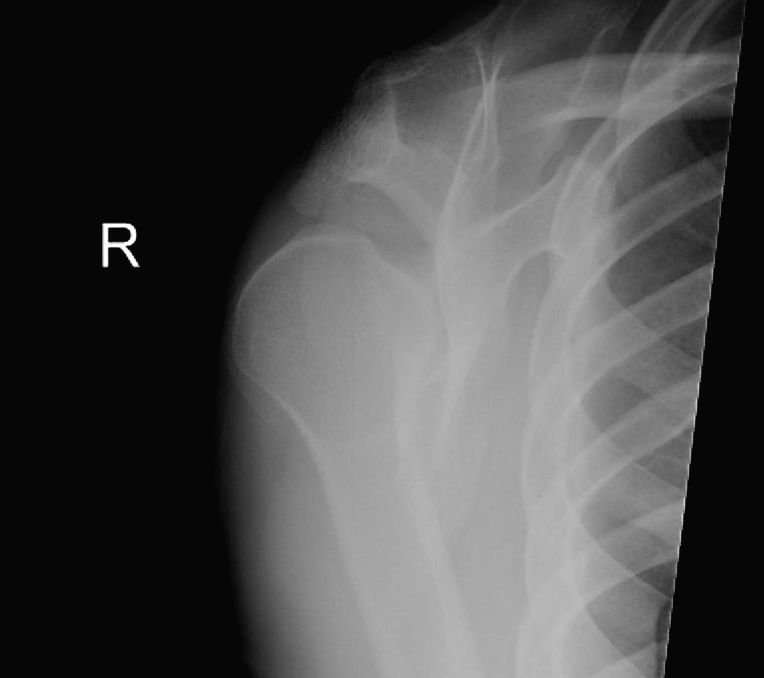 Posterior Shoulder Dislocation Scapula Lateral